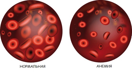 Вид крови при анемии