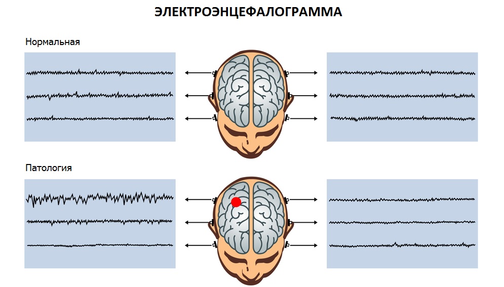 Диагностика эпилепсии с помощью ЭЭГ